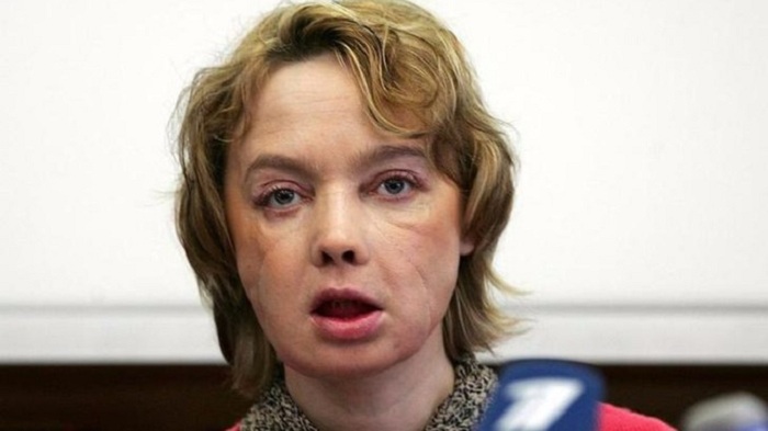 Woman who received world`s first face transplant dies at age 49